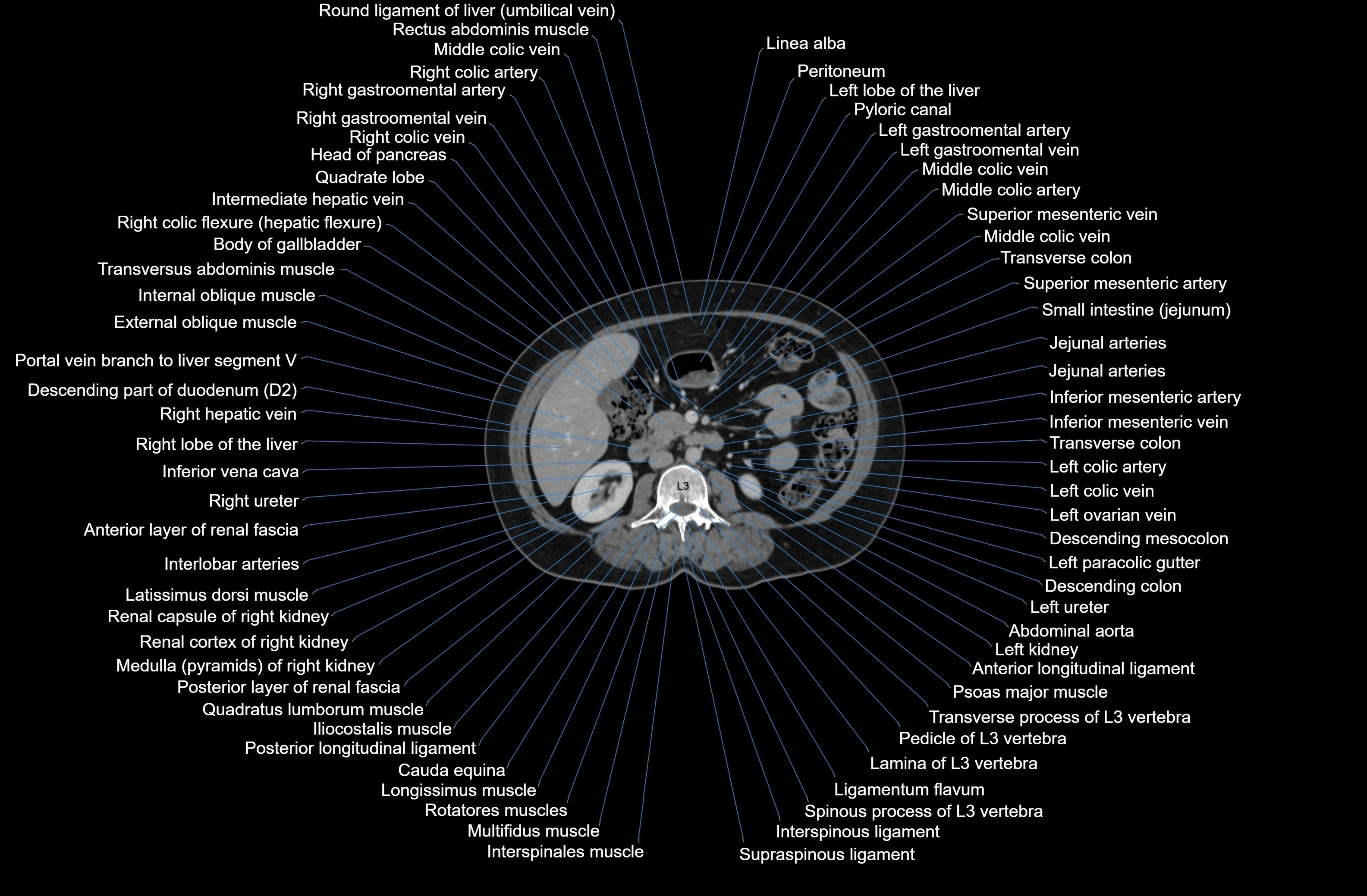 CT Abdomen axial cross sectional anatomy labelled radiology image-00042.webp